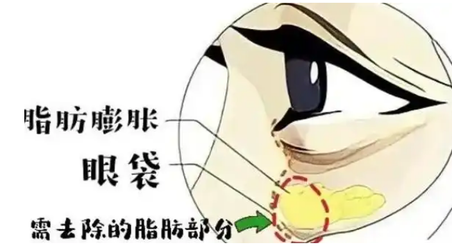 眼袋