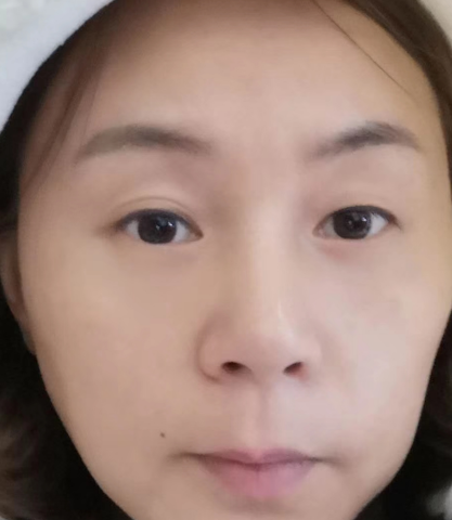 去眼袋手术