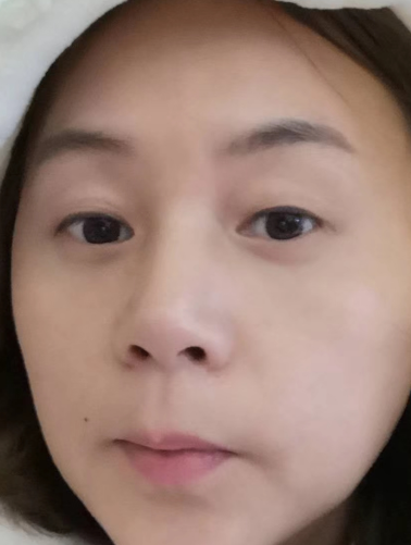 去眼袋手术