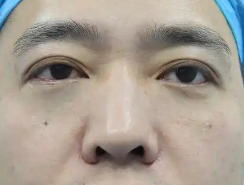 去眼袋手术