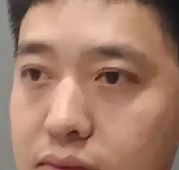 去眼袋手术