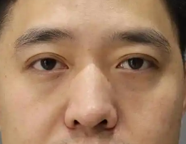 去眼袋手术