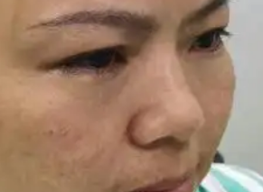 去眼袋手术