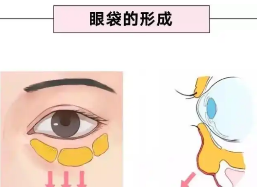 去眼袋手术