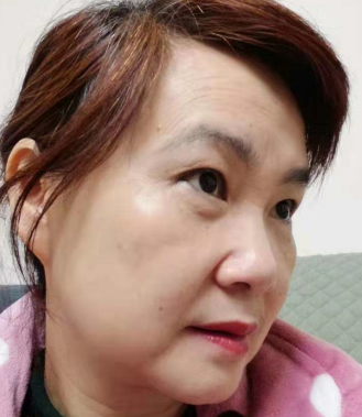 去眼袋手术