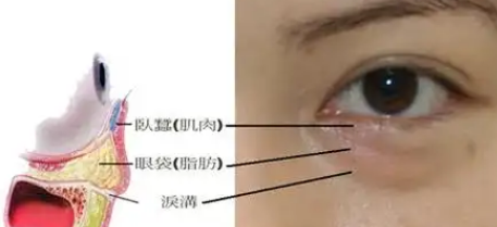 去眼袋手术