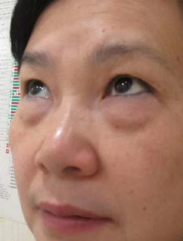 去眼袋手术
