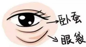 去眼袋手术