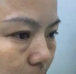 去眼袋手术