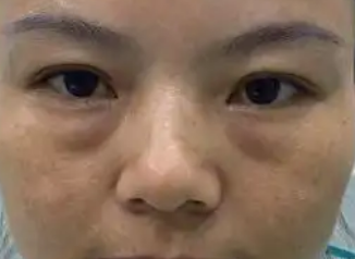 去眼袋手术