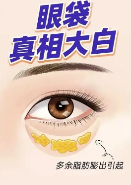 去眼袋手术