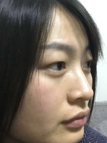 去眼袋手术