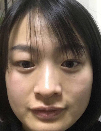 去眼袋手术