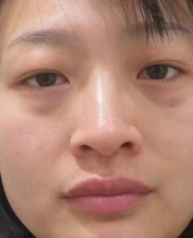 去眼袋手术