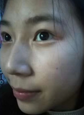 去眼袋手术