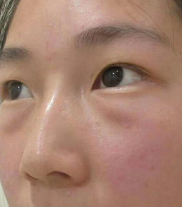 去眼袋手术