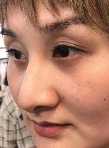 去眼袋手术