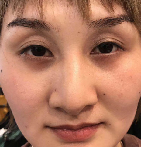 去眼袋手术