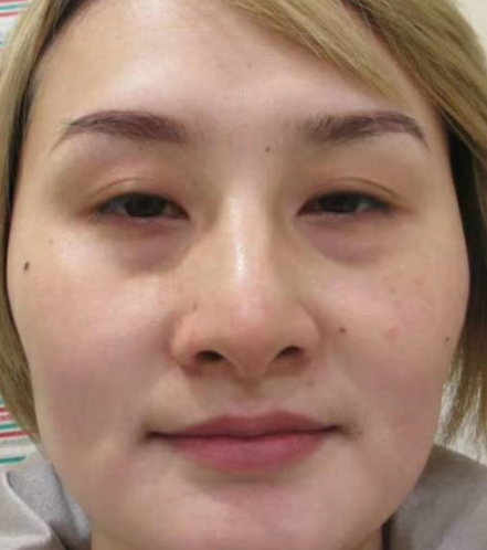 去眼袋手术