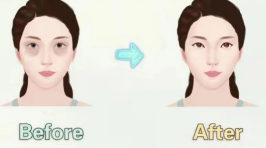 去眼袋手术