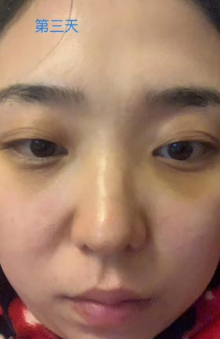 去眼袋手术