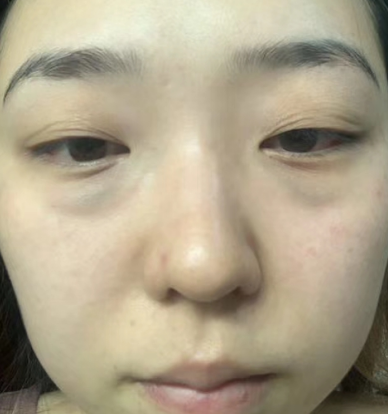 去眼袋手术