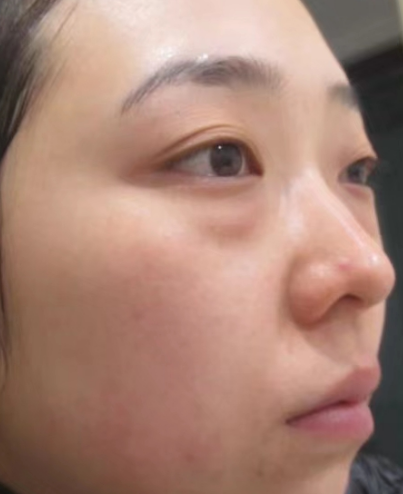 去眼袋手术