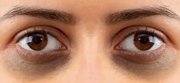 眼袋