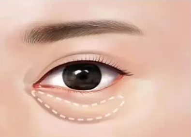 眼袋