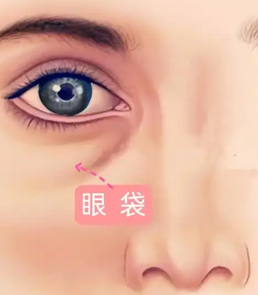 眼袋