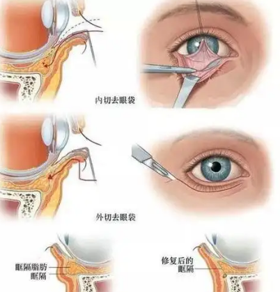 眼袋
