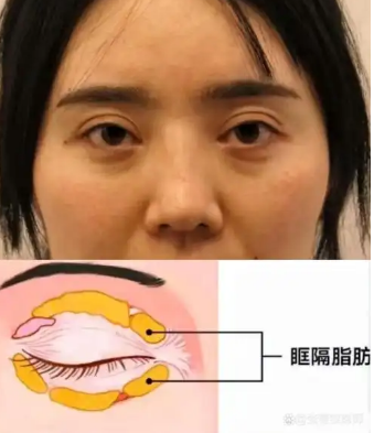 眼袋