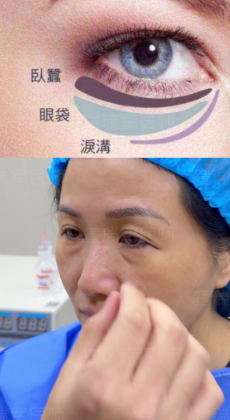 眼袋