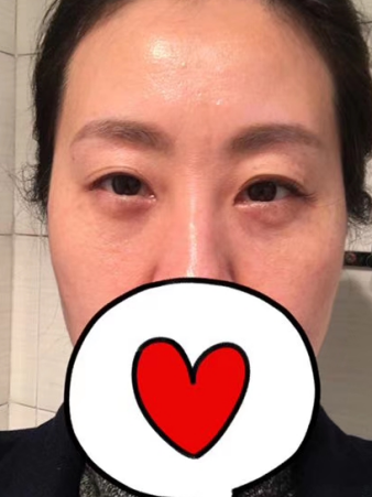 去眼袋手术