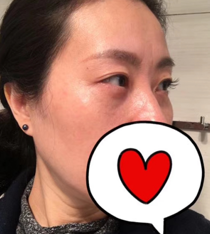 去眼袋手术
