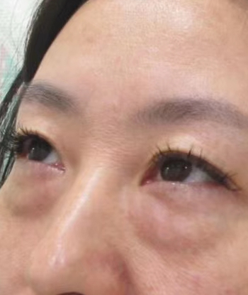 去眼袋手术
