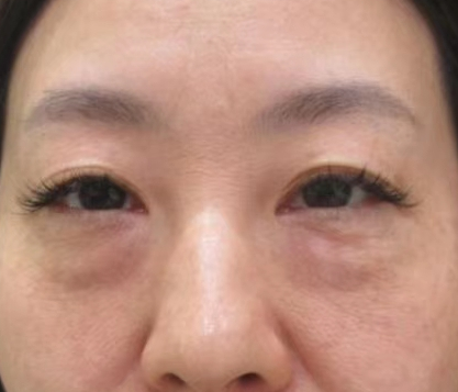 去眼袋手术