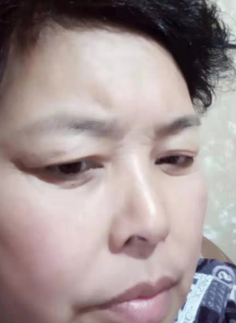 去眼袋手术