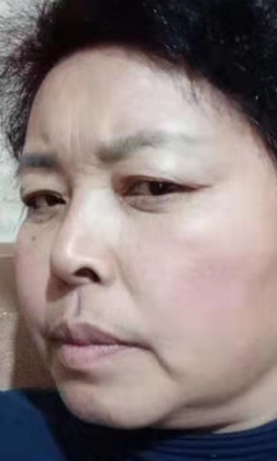 去眼袋手术