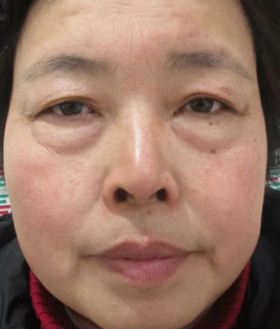 去眼袋手术