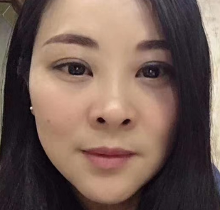 去眼袋手术