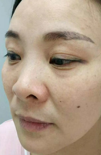 去眼袋手术