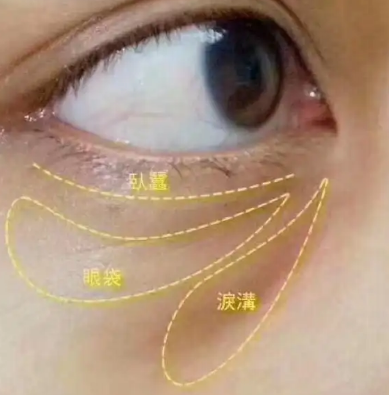 去眼袋手术