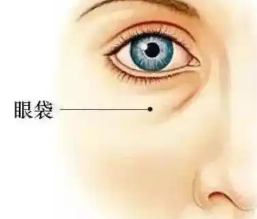 去眼袋手术