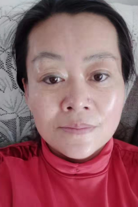去眼袋手术