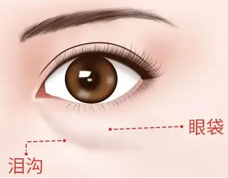 去眼袋手术