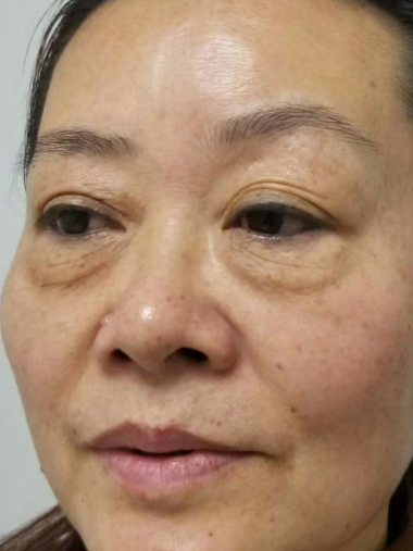 去眼袋手术
