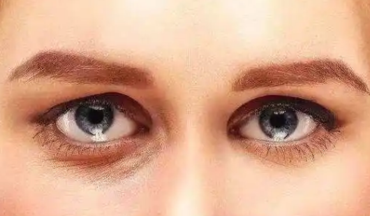 去眼袋手术