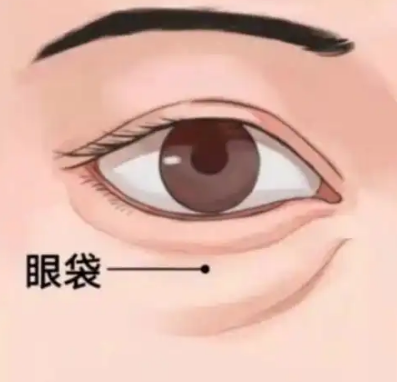 去眼袋手术