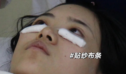 去眼袋手术
